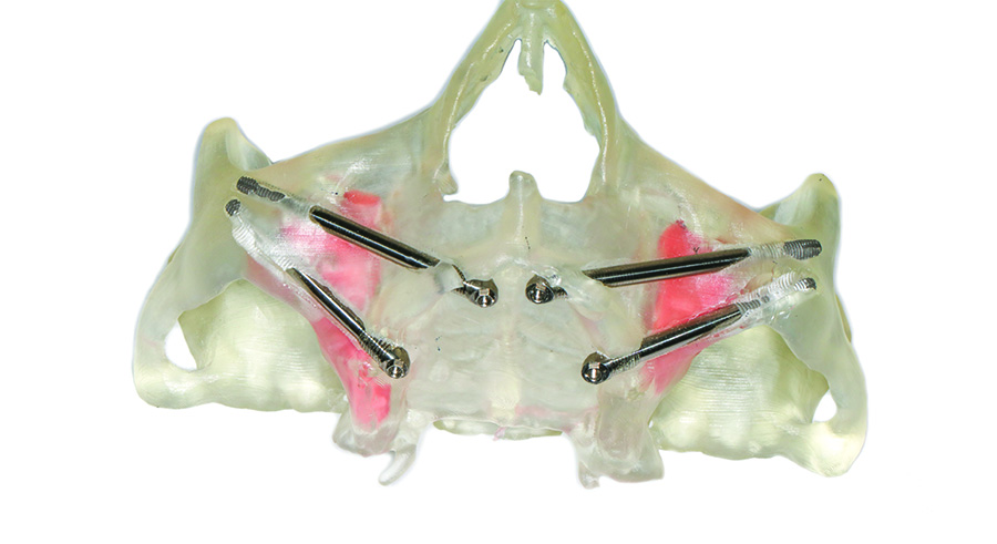 Przykładowe zestawienie czaszek wydrukowanych na drukarce 3D wraz z implantami jarzmowymi