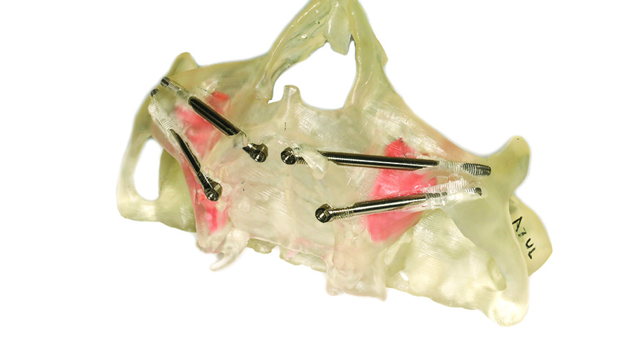 Przykładowe zestawienie czaszek wydrukowanych na drukarce 3D wraz z implantami jarzmowymi